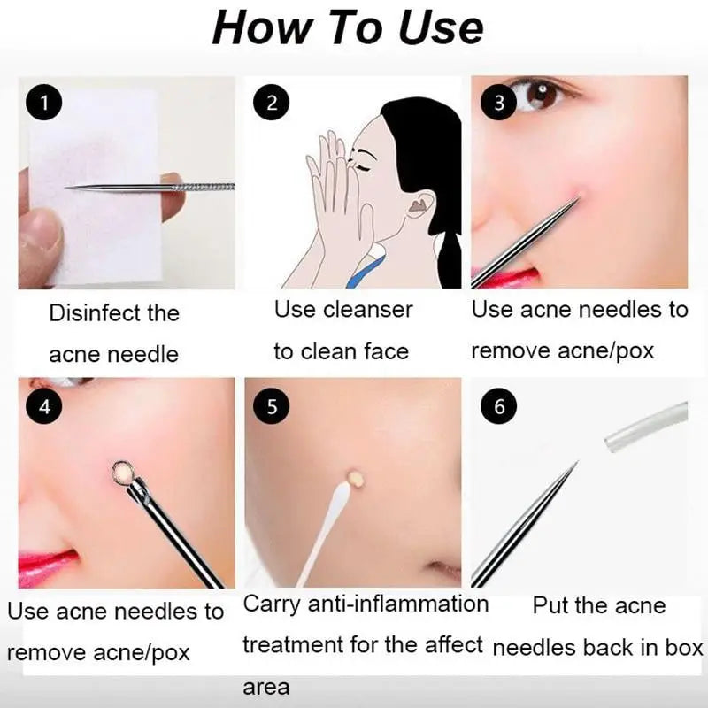 Acne Removal Tools Pimple Blackhead Remover Facial Pore Cleaner Stainless Steel with case - Skin Care tools - ALLURELATION - 576, Acne blackhead extractor, Acne remover, Face beauty, Face cleaning, Face skin care tools, Gadget, Pimple popper, Pore cleaner, Skin, Skin beauty tools, Skin care, Skin care tools - Stevvex.com